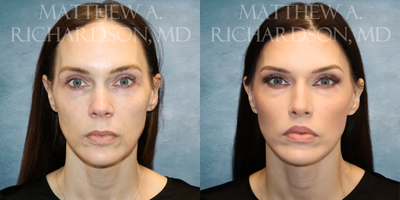 45-54 year old woman treated with Facelift, Forehead Reduction, Lip Lift, Facial Fat Transfer, CO2 Laser - 45-54 year old woman treated with Facelift, Forehead Reduction, Lip Lift, Facial Fat Transfer, CO2 Laser