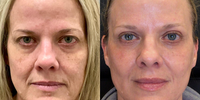 45-54 year old woman treated with CO2 Laser, Eyelid Surgery, Lip Fillers, Xeomin - This patient was thrilled with her results. Two weeks of downtime for such a dramatic result. Notice how much the CO2 improved her lower eyelids as well.