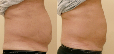 Man treated with UltraShape - Man treated with UltraShape