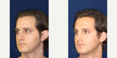 Permanent Non-surgical Rhinoplasty - Correction of unsightly pinched tip.