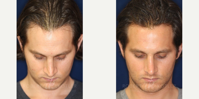 Permanent Non-surgical Rhinoplasty - Correction of unsightly pinched tip.