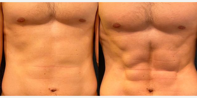 Man treated with truSculpt iD - One 45-minute treatment with truSculpt Flex is equivalent to 54,000 crunches! Take that hard work in the gym to the next level! With truSculpt Flex we can target specific muscles groups to tone! Pictured above is after 4 treatments of truSculpt Flex!