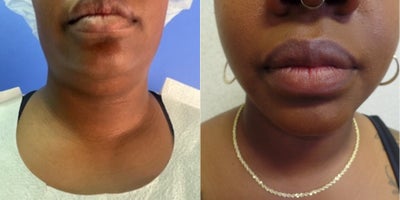 35-44 year old woman treated with FaceTite - FaceTite and Liposuction