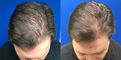 55-64 year old man treated with PRP for Hair Loss - This good looking guy had some thinning of his hair and early male pattern baldness. We have done two treatments of our specialized PRP preparation.