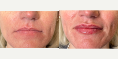 45-54 year old woman treated with Lip Fillers, Juvederm, Vollure - Patient received 2cc of Juvederm Vollure to the lips over 2 appointments a month apart.