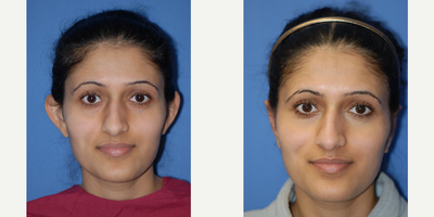 25-34 year old woman treated with Ear Surgery - Natural result after setting the ears back