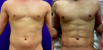 25-34 year old man treated with Body Jet - 3 weeks post operative hi definition liposuction of the stomach, chest, arms and shoulders with fat transfer to the chest, shoulders and buttock.