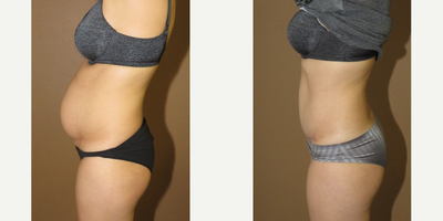 25-34 year old woman treated with Tummy Tuck - The only way to get rid of this post pregnancy bulge is to undergo abdominoplasty. Tummy tuck is the only solution to the stretched muscles. She lost all the weight she could but loose abdominal wall is not fixable without surgery .&nbsp;