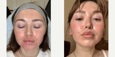 SELFIE SCARS | ACNE COMBO - Our patient has some very deep acne scars that have hurt her confidence for a long time, so she's ready to get rid of them. We did a combination treatment of punch excisions, Halo and CO2 lasers, PDO After Goo, and of course our favorite- the Emer Skin Hydration mask. Combining all of these treatments are not only going to help stimulate collagen reproduction but also help soften her acne scars as well as her skin's overall texture. Needless to say, she could not be happier with her results and is loving her smooth and rejuvenated skin.PUNCH EXCISIONHALO LASERCO2 LASERPDO AFTER GLOEMER SKIN HYDRATION MASKNo treatment is complete without EMER SKIN. Using our products post-treatment will enhance results to the absolute maximum. Click Link in Bio Click Emer Skin