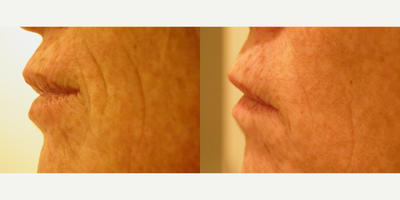 45-54 year old woman treated with Affirm Laser - 54 yo smoker patient who had her parenthesis lines treated with Affirm Laser.
