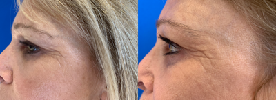 45-54 year old woman treated with Belotero - Combination of Belotero with Xeomin on a patient who had Lupus.