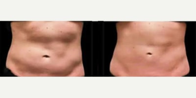 Woman treated with CoolSculpting - Woman treated with CoolSculpting. Patient is shown before and 8 weeks after treatment.