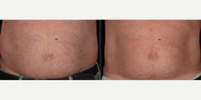 Man treated with CoolSculpting - Man treated with CoolSculpting. Patient is shown before and 75 days after one treatment.