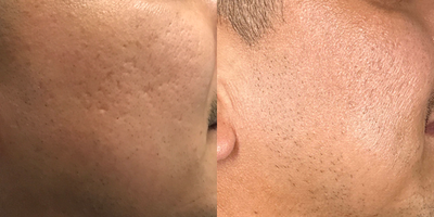 35-44 year old man treated with Dermapen - 39-year old male treated with Dermapen for Acne Scarring and enlarged pores