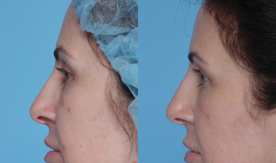 Active FX and Deep FX - 
	49 Year Old Female Before and 1 Month After Full Face Active FX and Deep FX Around Eyes
