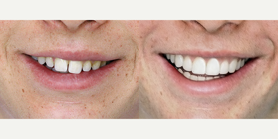 No-Prep Dental Veneers - No Preparation Dental Veneers are a minimally invasive treatment option for patients with teeth that can be modified by adding ultra-thin porcelain material with minimal to no preparation of adjacent or underlying tooth structure. Treatment success depends on proper case selection, advanced adhesive bonding techniques, and excellent communication between the patient and the clinician. Before this no-prep dental veneer treatment, the patient was provided with mock-ups for approval.