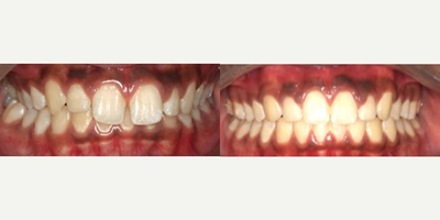 17 or under year old man treated with Damon Braces - Deep bite and class II malocclusion treated with Damon braces for 14 months with elastic  sat Impressions orthodontics, Calgary