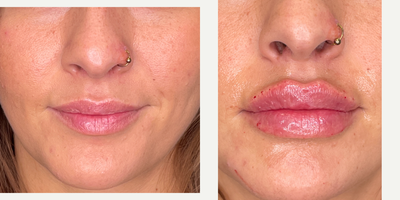 25-34 year old woman treated with Lip Fillers, Revanesse - patient treated with 1 syringe of revanesse lips