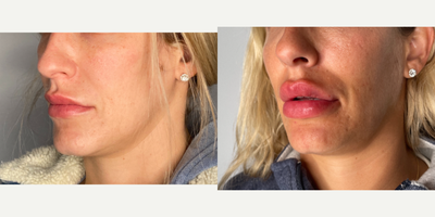 35-44 year old woman treated with Lip Fillers, Revanesse - patient treated with 1 syringe of revanesse lips