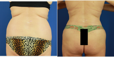 55-64 year old woman treated with Liposuction, Liposculpture, Skin Rejuvenation, Power-Assisted Liposuction (PAL) - 3 months post circumferential liposuction with renuvion skin tightening.