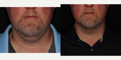 45-54 year old man treated with PrecisionTx - A single session of Precision TX was performed to treat this double chin.