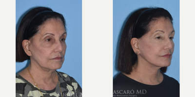 77 year old woman treated with Facelift Revision - 77 year old woman treated with Facelift Revision. Pre-op, patient was unhappy with the results from a previous procedure done by another doctor. Patient is shown before and 9 months post-op.