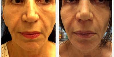 65-74 year old woman treated with Silhouette InstaLift  Contour Thread Lift - Silhouette InstaLift Suture Lift. less than one hour office procedure.