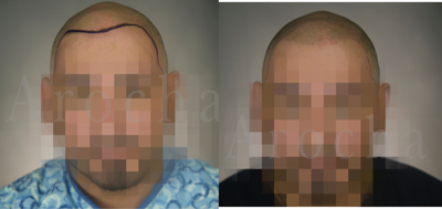 25-34 year old man treated with Scalp Micropigmentation - This patient came to Dr. Arocha with thinning throughout the entire scalp. He wore his hair in a buzzed style in an attempt to conceal the thinning spots. Dr. Arocha and his team performed scalp trico-pigmentation to give this patient the appearance of full coverage. To date, the patient has done two trico-pigmentation sessions and will be returning for his third in the near future.
