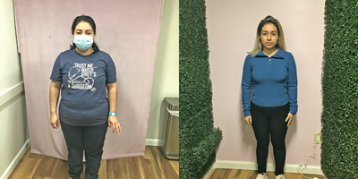 35-44 year old woman treated with Orbera Gastric Balloon, Gastric Balloon - Our patient lost 56 lbs after her Orbera Gastric Balloon.