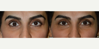 A young female, with sunken right eye (enophthalmos) from trauma, who underwent corrective surgery. - A young female, with sunken right eye (enophthalmos) from trauma, who underwent corrective surgery by placing right orbital implant.  Note the right eyeball is sunken and lower than the left eyeball before surgery but it gets corrected after surgery.