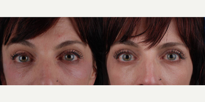 35-44 year old woman treated with TCA Peel - One month after TCA Peel.
