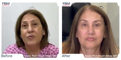 45-54 year old woman treated with Deep Plane Facelift, Facelift, Facial Fat Transfer, Eyelid Surgery - Treated with Deep Plane Facelift, Facelift, Facial Fat Transfer, Eyelid Surgery
