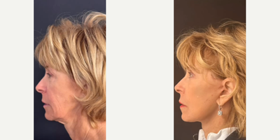 Woman treated with Neck Lift - Woman treated with Deep Plane Facelift, Neck Lift, Lateral Brow Lift, and Facial Fat Transfer.
