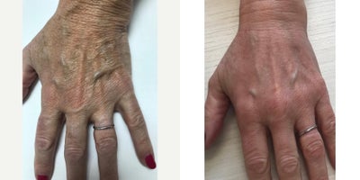 55-64 year old woman treated with Fractional Laser - Three for Me treatment Impulsed light combined with Fractional Laser stimulated collagen resulting in younger looking skin.