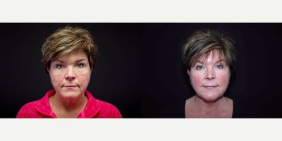 55-64 year old woman treated with Bellafill - 57 year old female received Bellafill to Perioral; photos depict the patients results 3 months post-op.