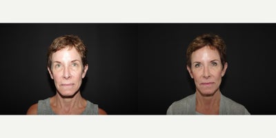 55-64 year old woman treated with Bellafill - 62 year old female received 2 syringes of Bellafill to the temples and around the eyes; photos depict the patients results 3 months post-op.