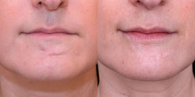 25-34 year old female scar removal with excision followed by dermabrasion and DeepFX laser resurfacing, - Excision followed by dermabrasion and DeepFX laser resurfacing, and vascular laser treatments.