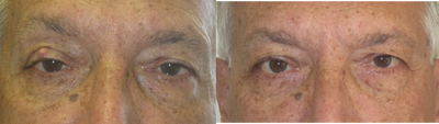 Right upper lid cyst. - 	Excision of right upper lid cyst with eyelid reconstruction.