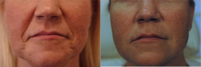 45-54 year old woman treated with Radiesse for Laugh Lines - Radiesse Injections laugh lines.
