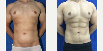 25-34 year old woman treated with Abdominal Etching - This patient in his late 20s desired sick-pack abs. He underwent VASER Hi-Def Liposuction to remove excess fat of his abdomen to chisel out his abs.