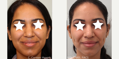 25-34 year old woman treated with Dimple Surgery - Cheek dimple surgery / dimpleplasty