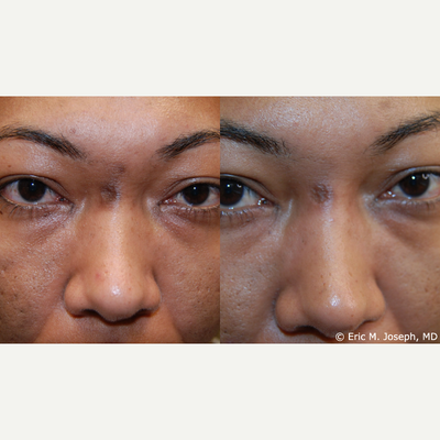 Acne Scar Correction Before & After: Improved Hyperpigmentation - Our 38 year old patient was bothered by the dark scar at the root of her nose. We filled it twice with Microdroplet Silikon-1000, and she has been diligent using our bleaching cream, and SPF. You can see a smoother, and less indented scar with improved hyperpigmentation. For many people with depressed scars, Microdroplet Silikon-1000 may be a wonderful alternative to temporary fillers or other more invasive procedures.