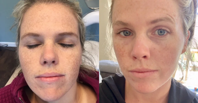 25-34 year old woman treated with Vi Peel - A VI Peel is always a great start to an amazing skincare regimen! We customize each treatment to help meet individual goals.
