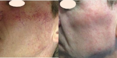 Man treated with Excel V - Man treated with Excel V