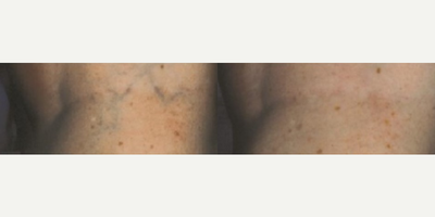 Woman treated with Excel V - Woman treated with Excel V