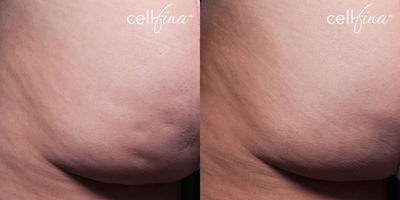 45-54 year old woman treated with Cellfina - 47-year-old female patient treated for cellulite on buttocks.