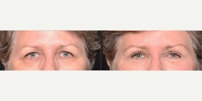 Woman treated with Eyelid Surgery - Woman treated with Eyelid Surgery.