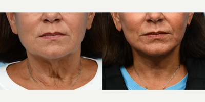 65-74 year old woman treated with Deep Plane Facelift, Facelift, Neck Lift - 67-year-oldpatient with facial aging, jowling, and prominent platysmal bands underwent a deep plane facelift and platysmaplasty. The procedure addressed the jowls, recreated the jaw line, and treated the mid-face laxity. In addition, a neck lift was performed to give the patient'sneck a more contoured and youthful appearance.