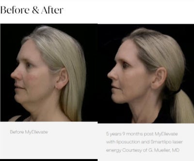 51 year old woman treated with MyEllevate - MyEllevate with liposuction and RF energy.