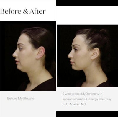 25 year old woman treated with MyEllevate - MyEllevate with liposuction and RF energy.